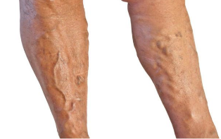 Tratamento de veias varicosas nas pernas