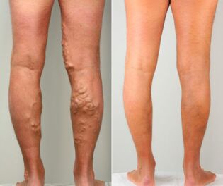 Estágios das veias varicosas das pernas