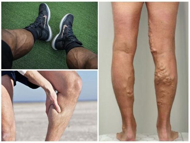 como são as veias varicosas nas pernas dos homens