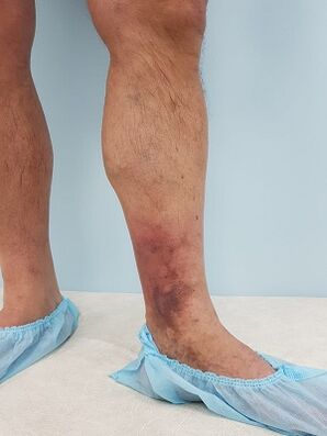 complicações de varizes em homens