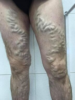 varizes masculinas negligenciadas