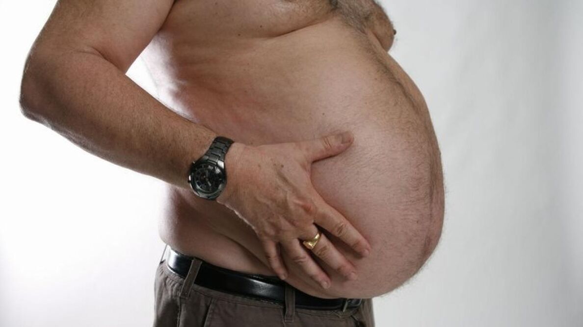 obesidade como causa do desenvolvimento de veias varicosas