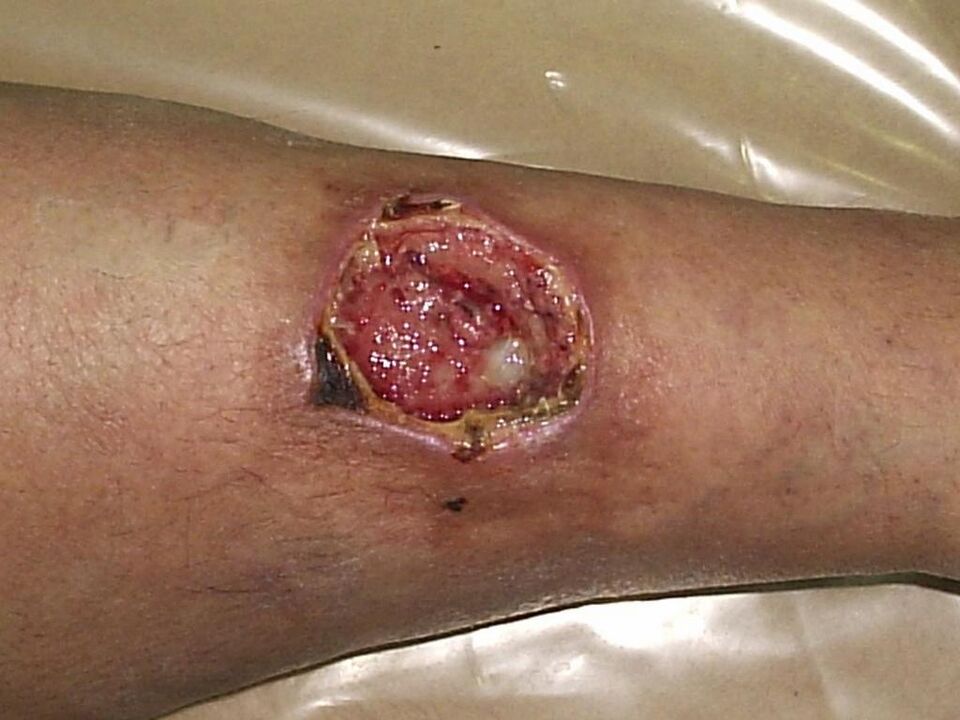 úlcera trófica com varizes avançadas