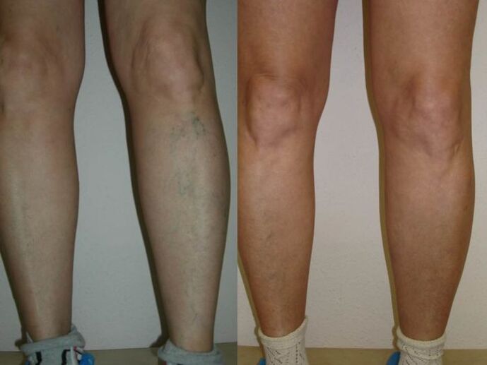 pernas antes e depois do tratamento a laser de veias varicosas
