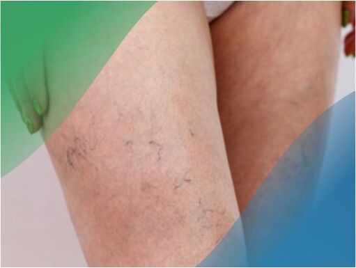 A rede vascular nas pernas é um dos sintomas das varizes