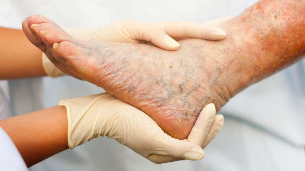 O flebologista lida com o tratamento de varizes nas pernas