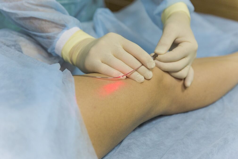 Tratamento a laser de varizes das extremidades inferiores