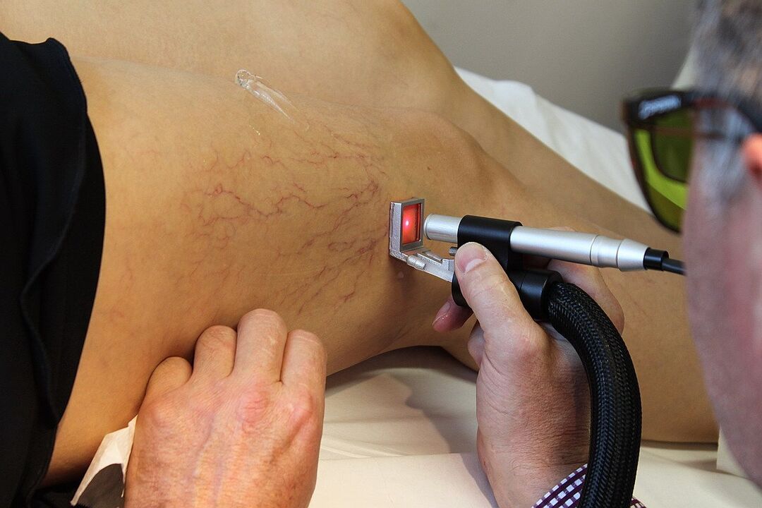 Coagulação a laser