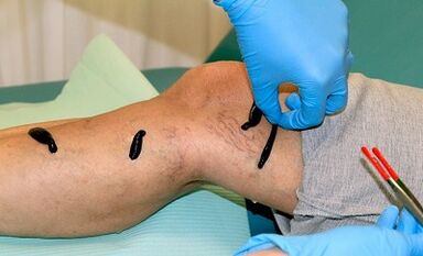 Hirudoterapia para varizes