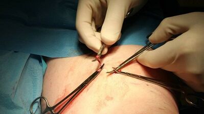 Flebectomia para varizes