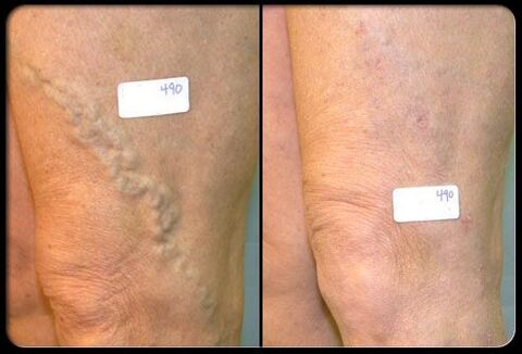 Antes e depois da cirurgia nas veias