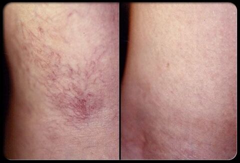 Antes e depois da escleroterapia