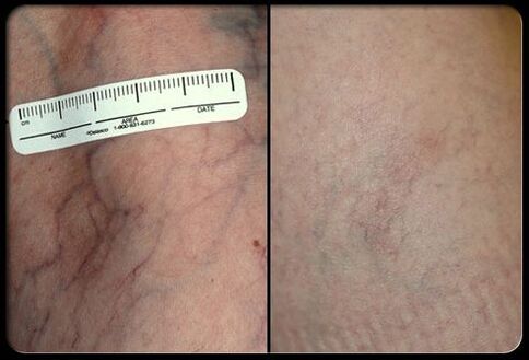 Antes e depois do procedimento de terapia a laser